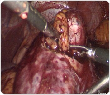 Excision of the Mass (Nephrolithotomy