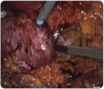 Laparoscopy Assisted PCNL (Percutaneous Nephrolithotomy