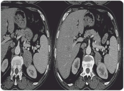 Left Adrenal Tumour Excision