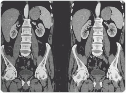 Left Adrenal Tumour Excision