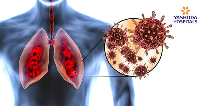 Lung or Respiratory complications