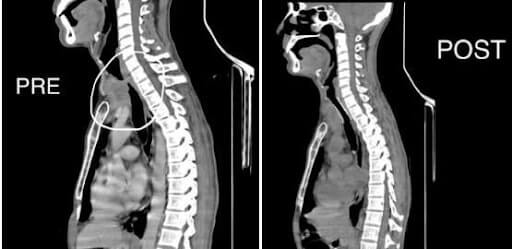 Malignant central airway obstruction