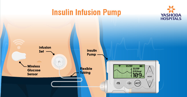 Managing Diabetes with Insulin Pumps