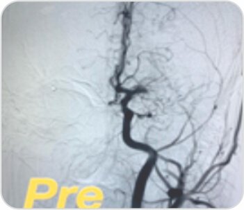 Mechanical Thrombectomy for Acute Right Hemiparesis and Aphasia