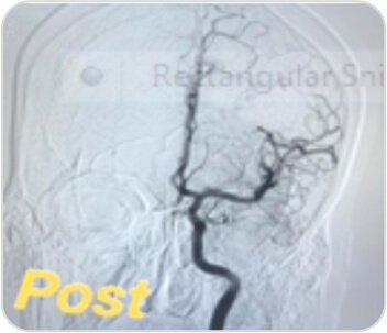 Mechanical Thrombectomy for Acute Right Hemiparesis and Aphasia