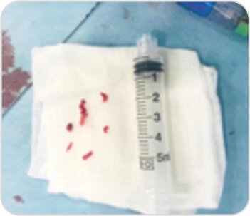 Mechanical Thrombectomy for Acute Right Hemiparesis and Aphasia