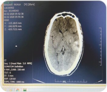 Mechanical Thrombectomy for Acute Right Hemiparesis and Aphasia