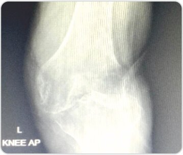 Distal Femoral Replacement for Severe Osteoarthritis Knee With Osteoporotic Distal Femoral Fracture