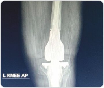 Distal Femoral Replacement for Severe Osteoarthritis Knee With Osteoporotic Distal Femoral Fracture