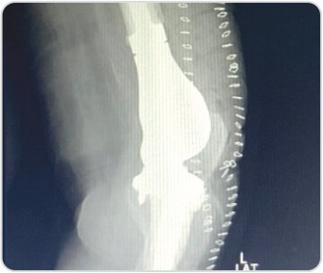 Distal Femoral Replacement for Severe Osteoarthritis Knee With Osteoporotic Distal Femoral Fracture