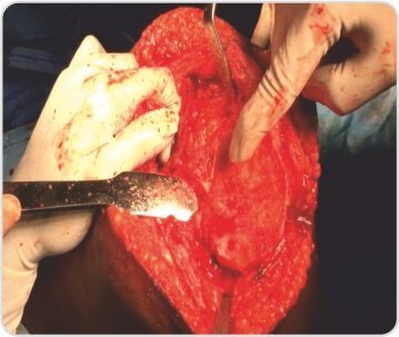 Distal Femoral Replacement for Severe Osteoarthritis Knee With Osteoporotic Distal Femoral Fracture