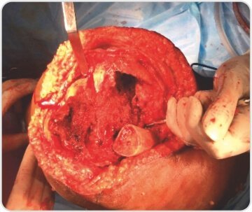 Distal Femoral Replacement for Severe Osteoarthritis Knee With Osteoporotic Distal Femoral Fracture