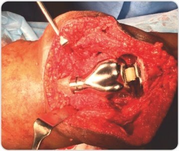 Distal Femoral Replacement for Severe Osteoarthritis Knee With Osteoporotic Distal Femoral Fracture