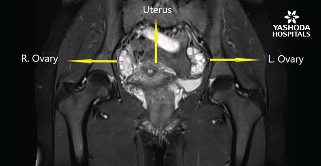 Transvaginal ultrasound