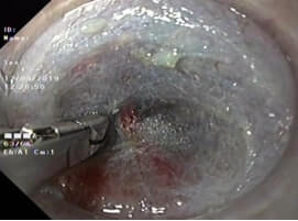 Peroral endoscopic Myotomy (POEM) - Achalasia Cardia