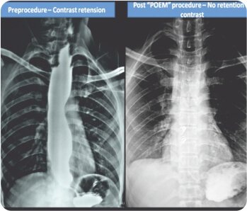 Per Oral Endoscopic Myotomy For Achalasia Cardia