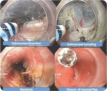 Per Oral Endoscopic Myotomy For Achalasia Cardia