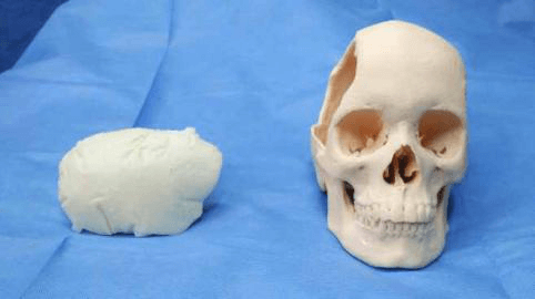 3d printed skull