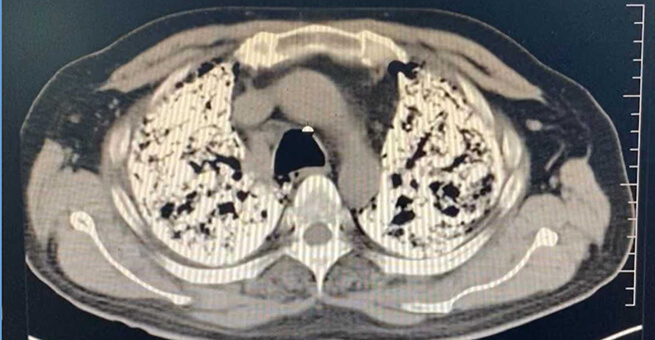 Pulmonary Alveolar Microlithiasis finding