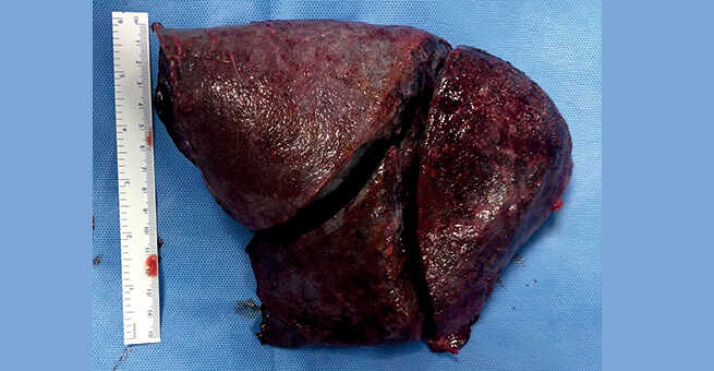 Pulmonary Alveolar Microlithiasis post operative