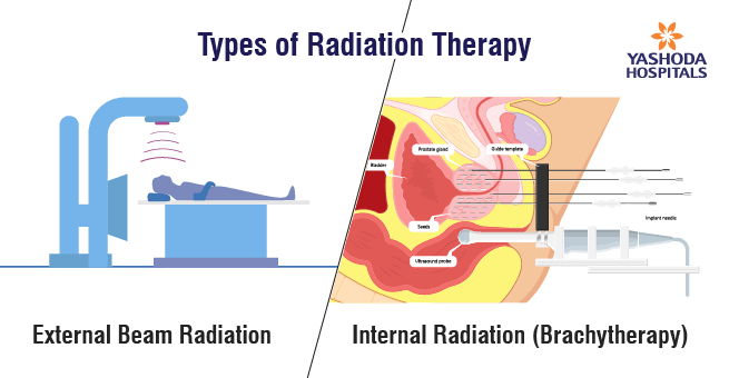 Radiation Oncology in Cancer Treatment