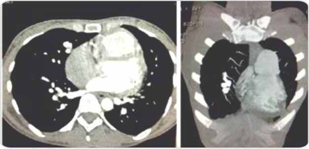 Recurrent Pulmonary Arteriovenous Malformation Treated withEmbolization