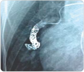 Recurrent Pulmonary Arteriovenous Malformation Treated withEmbolization