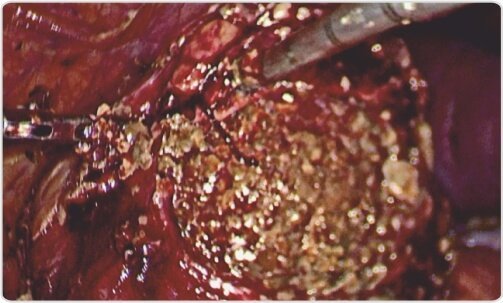 Giant Renal Pelvic Calculus Removed Laparoscopically  in Toto