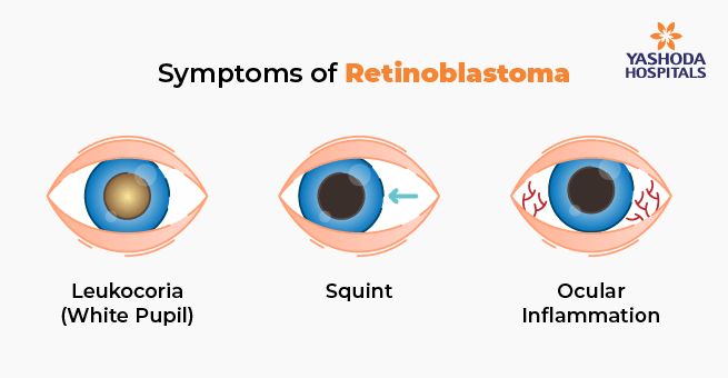 Retinoblastoma in Children_Body 2