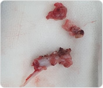 Right Arterial TOS (Thoracic Outlet Syndrome) Decompression by Cervical Rib Excision for Acute Upper Limb Ischemia