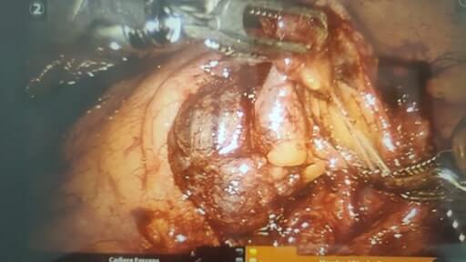 Robotic left mediastinal tumor excision