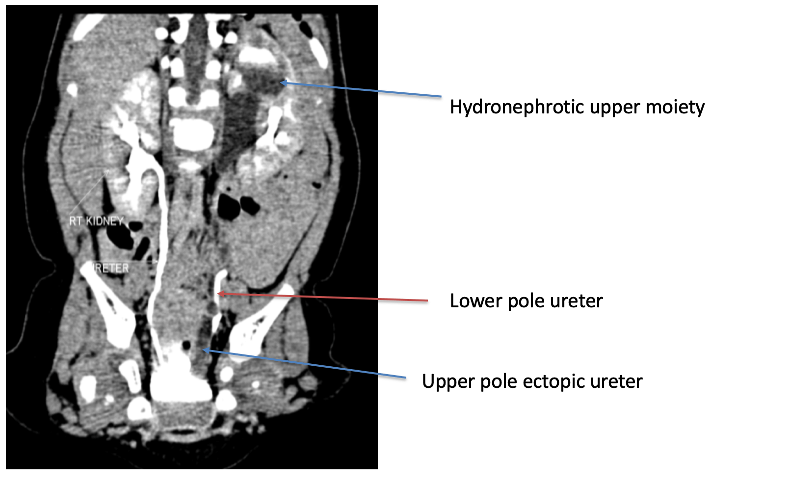 Robotic surgery CT UROGRAM