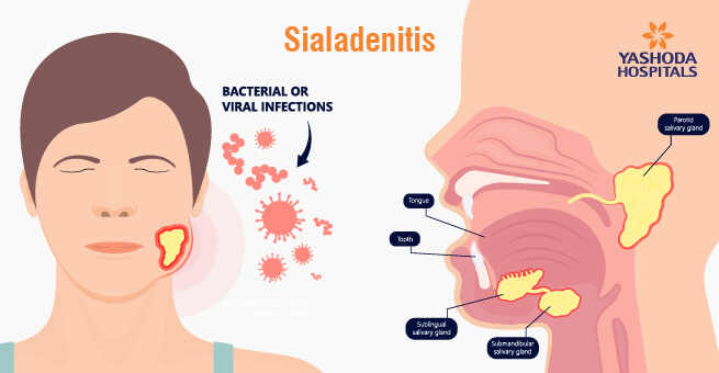 Sialendoscopy1