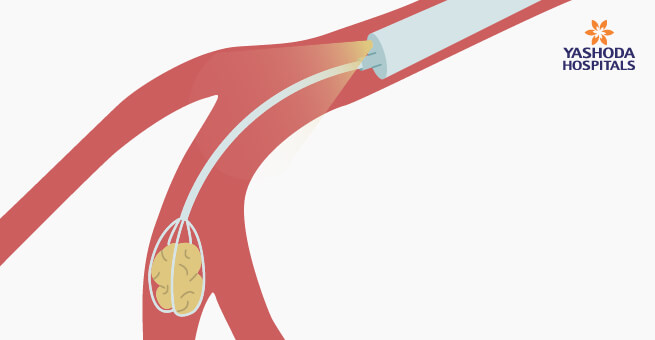 Sialendoscopy2