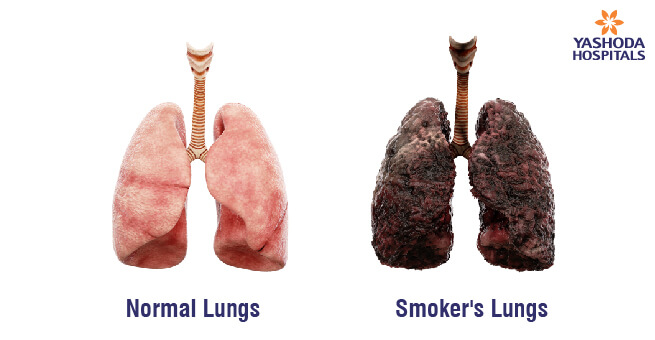 Smoking on Lung Health