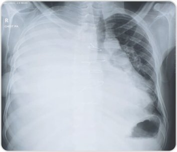 Video-Assisted Thoracoscopic Surgery of Solitary Fibrous Pleural Tumor