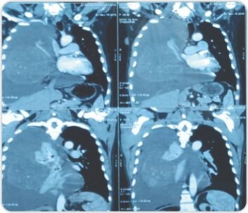 Video-Assisted Thoracoscopic Surgery of Solitary Fibrous Pleural Tumor