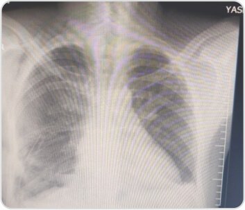 Video-Assisted Thoracoscopic Surgery of Solitary Fibrous Pleural Tumor