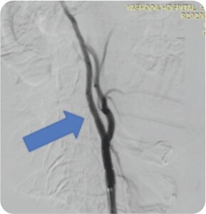 Symptomatic Carotid Near Total Occlusion Treated by Carotid Stenting