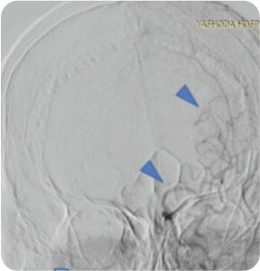 Symptomatic Carotid Near Total Occlusion Treated by Carotid Stenting