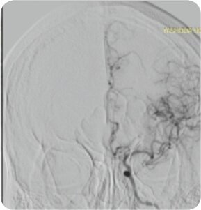 Symptomatic Carotid Near Total Occlusion Treated by Carotid Stenting