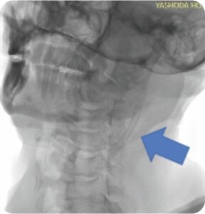 Symptomatic Carotid Near Total Occlusion Treated by Carotid Stenting