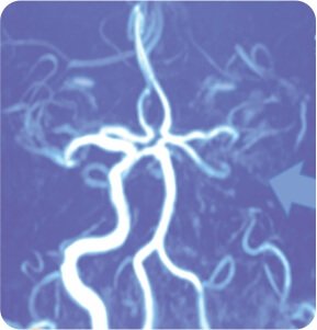 Symptomatic Carotid Near Total Occlusion Treated by Carotid Stenting