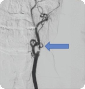 Symptomatic Carotid Near Total Occlusion Treated by Carotid Stenting