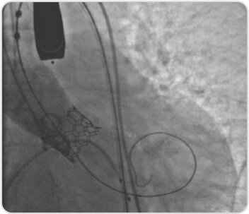 Trans Catheter Aortic Valve Implantation (TAVI)