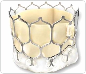 Trans Catheter Aortic Valve Implantation (TAVI)