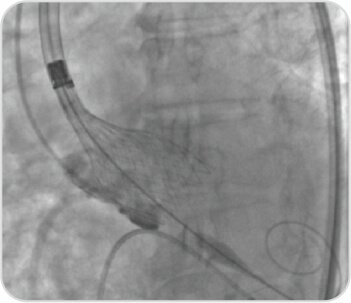 Trans Catheter Aortic Valve Implantation (TAVI)