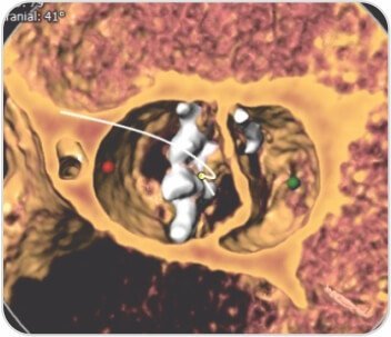 Trans Catheter Aortic Valve Implantation (TAVI)