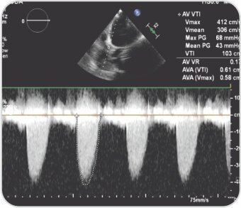 Trans Catheter Aortic Valve Implantation (TAVI)