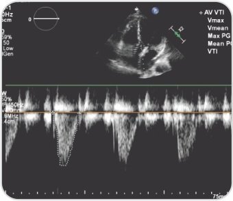 Trans Catheter Aortic Valve Implantation (TAVI)